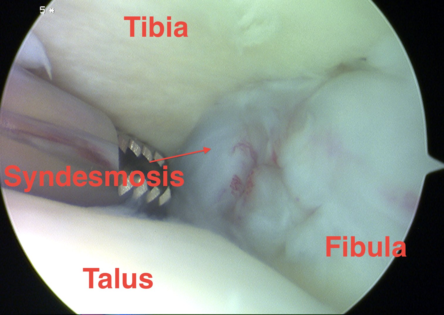 Ankle Arthroscopy Lateral Gutter